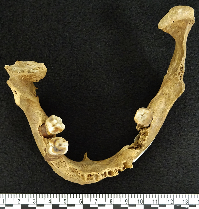 photo of human jaw bone